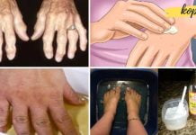 სცადეთ ეს ხალხური საშუალებები და ერთხელ და სამუდამოდ მოიშორეთ ართრიტი და ტკივილი! ტკივილის შემსუბუქება მარტივი მეთოდით!