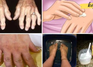 სცადეთ ეს ხალხური საშუალებები და ერთხელ და სამუდამოდ მოიშორეთ ართრიტი და ტკივილი! ტკივილის შემსუბუქება მარტივი მეთოდით!