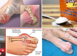 როგორ ავიცილოთ თავიდან პოდაგრა და სახსრების ტკივილი ორგანიზმიდან შარდმჟავას გამოდევნით! ეს მართლაც წარმოუდგენლად ეფექტურია!