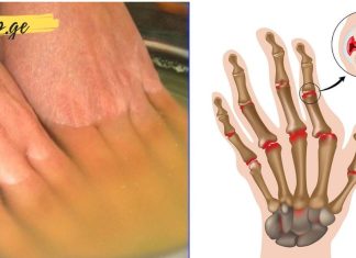 თუ თქვენ განიცდით აუტანელ და საშინელ ტკივილს ხელებსა და სახსრებში. თუ გაქვთ ართრიტი. ეს ეფექტური ხალხური მეთოდი დაგეხმარებათ…