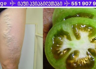 მე ვარიკოზულ ვენებს მწვანე პომიდორის გამოყენებით ვუმკურნალე! თუ შენც გაწუხებს ეს პრობლემა გირჩევ სცადო!!.