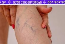 რა უნდა გააკეთო, თუ ფეხზე ვენები გასკდება! ამის ცოდნა აუცილებელია!