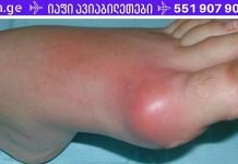 დაემშვიდობეთ პოდაგრას ამ ძლიერი ბუნებრივი სამკურნალო საშუალებით! (რეცეპტი)