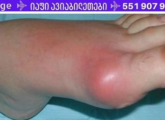 დაემშვიდობეთ პოდაგრას ამ ძლიერი ბუნებრივი სამკურნალო საშუალებით! (რეცეპტი)