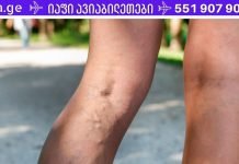 თუ ვარიკოზული ვენები გაწუხებს, აუცილებლად დაიწყე ამ ვარჯიშების გაკეთება!