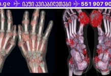 აკონტროლეთ შარდმჟავას დონე თქვენს ორგანიზმში! შედეგები შეიძლება იყოს შეუქცევადი!