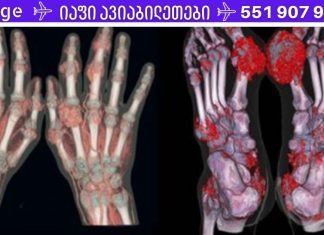 აკონტროლეთ შარდმჟავას დონე თქვენს ორგანიზმში! შედეგები შეიძლება იყოს შეუქცევადი!