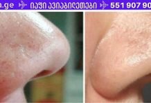 მოიშორეთ ეს საშინელი შავი წერტილები ახლავე! და აი, როგორ უნდა გააკეთოთ ეს…