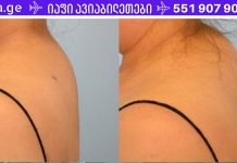 როგორ ვუმკურნალოთ კისერზე დაგროვილ მარილებს? გამომწვევი მიზეზები და მკურნალობა..
