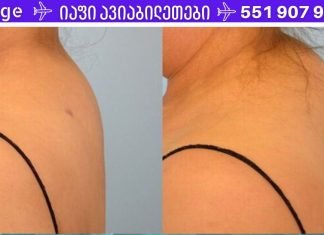 როგორ ვუმკურნალოთ კისერზე დაგროვილ მარილებს? გამომწვევი მიზეზები და მკურნალობა..