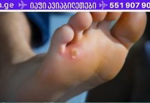 როგორ ვუმკურნალოთ მაზოლებს ბუნებრივად? ეს ბუნებრივი საშუალებები დაგეხმარებათ..