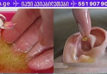 დაემშვიდობეთ ყურის ინფექციებს! აი, როგორ განვკურნოთ ინფექციები მხოლოდ 1 დღეში!