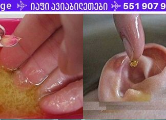 დაემშვიდობეთ ყურის ინფექციებს! აი, როგორ განვკურნოთ ინფექციები მხოლოდ 1 დღეში!