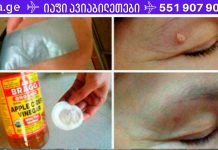 სწრაფად და ეფექტურად მოიცილეთ მეჭეჭები, მუქი ლაქები, შავი წერტილები და პაპილომები