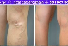 საუკეთესო ხალხური რეცეპტი ვარიკოზული ვენებისთვის! ეს მართლაც ჩემი მშველელია!!