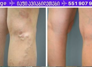საუკეთესო ხალხური რეცეპტი ვარიკოზული ვენებისთვის! ეს მართლაც ჩემი მშველელია!!