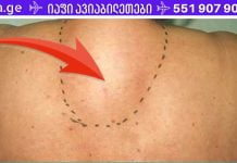 საშუალება, რომელიც დაგეხმარებათ კისერზე მარილის ყველაზე ქრონიკული დეპოზიტების მოცილებაშიც კი