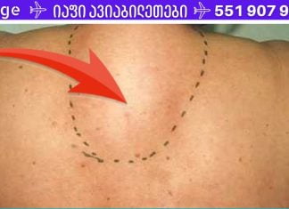 საშუალება, რომელიც დაგეხმარებათ კისერზე მარილის ყველაზე ქრონიკული დეპოზიტების მოცილებაშიც კი