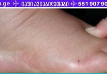 დაემშვიდობეთ სითხის დაგროვებას, შეშუპებასა და ჭარბ წონას ორგანიზმში! ამას დასჭირდება მხოლოდ 1 კვირა…