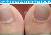 მოირჩინეთ ფრჩხილის სოკო კვერცხისა და ძმრის დახმარებით.. ეს ძალიან ეფექტური მეთოდია..