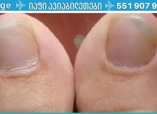 მოირჩინეთ ფრჩხილის სოკო კვერცხისა და ძმრის დახმარებით.. ეს ძალიან ეფექტური მეთოდია..