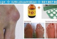 ასპირინისა და იოდის ნარევი მოგიხსნით პოდაგრას! ეს უნდა სცადოთ..