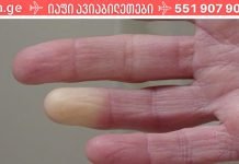 რაზე მიგვანიშნებს მუდმივად ცივი ხელები და ფეხები? არ ვიცოდი, რომ ასეთი სერიოზული იყო!