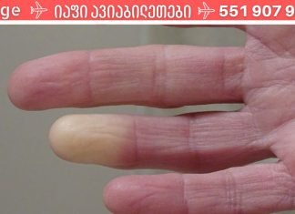 რაზე მიგვანიშნებს მუდმივად ცივი ხელები და ფეხები? არ ვიცოდი, რომ ასეთი სერიოზული იყო!