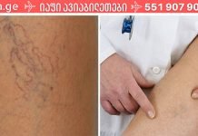 5 რჩევა, რომელიც დაგეხმარებათ ობობის ვენებისგან თავის დაღწევაში. მეორე რჩევა მტკიცედ შემოვიდა ჩემს ცხოვრებაში!