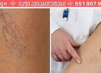 5 რჩევა, რომელიც დაგეხმარებათ ობობის ვენებისგან თავის დაღწევაში. მეორე რჩევა მტკიცედ შემოვიდა ჩემს ცხოვრებაში!