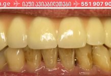 ჩემი 72 წლის ბაბუა არასოდეს ყოფილა სტომატოლოგთან… ის კვირაში 3-ჯერ იყენებს ამ ხელსაწყოს!