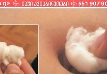 მოიცილეთ ხველა და გაციება ძალიან მარტივად! ამისათვის რაც თქვენ უნდა გააკეთოთ არის ჭიპში ალკოჰოლით გაჟღენთილი ბამბის დამაგრება..!