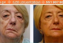 ინსულტის 7 ადრეული ნიშანი, რომლის შესახებ ყველამ უნდა იცოდეს! აუცილებლად წაიკითხეთ და გაგვიზიარეთ თქვენი ცოდნა! ეს ძალიან მნიშვნელოვანია!