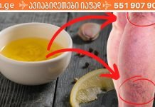 უმკურნალეთ ვარიკოზულ ვენებს ნიორით! ამაზე ეფექტური არაფერი მინახავს..