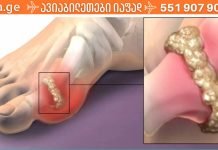 როგორ შლის შარდმჟავას ორგანიზმიდან ეს მარტივი წვენის რეცეპტი? ყველას აქვს ეს ინგრედიენტები!