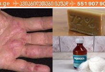 „ასჯერ ვთქვი და კიდევ ვიმეორებ! კანის ნებისმიერი დაავადება შეგიძლიათ იმკურნალოთ წყალადის ზეჟანგითა და სარეცხი საპნით”!