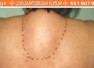 ვისაც კისერზე მარილები აქვს, ეს რეცეპტი გამოადგება.. საოცარია..