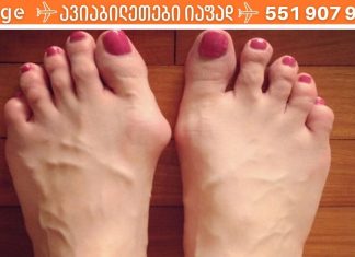 ბუნიონის მკურნალობა საშინაო ეთოდებით.. მე ამ გზით მოვიშორე საშინელი ტკივილები..