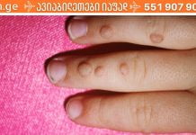 გამოიყენე წყალბადის ზეჟანგი და ერთხელ და სამუდამოდ მოიშორე მეჭეჭები და პაპილომები! ამაზე ეფექტური არაფერი არსებობს..