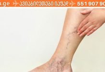 რატომ ჩნდება ვარიკოზული ვენები? როგორ ხდება ვარიკოზუი ვენების მკურნალობა სახლის პირობებში?