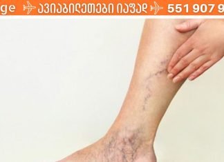 რატომ ჩნდება ვარიკოზული ვენები? როგორ ხდება ვარიკოზუი ვენების მკურნალობა სახლის პირობებში?