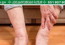 თუ ხელები ან ფეხები ხშირად გიცივდებათ, შეიძლება ეს ჯანმრთელობის პრობლემები გქონდეთ!