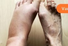 თუ სითხის დაგროვება და ორგანიზმის შეშუპება გაწუხებს, გამოიყენე ეს მეთოდი და სულ რაღაც ერთ კვირაში დაემშვიდობები ამ პრობლემას..