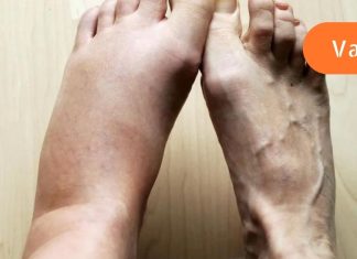 თუ სითხის დაგროვება და ორგანიზმის შეშუპება გაწუხებს, გამოიყენე ეს მეთოდი და სულ რაღაც ერთ კვირაში დაემშვიდობები ამ პრობლემას..