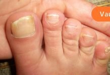 რამდენი ხანი მაწუხებდა ფეხის სოკო! ამის გამო ძალიან დაკომპლექსებული ვიყავი, ბოლოს იოდის დახმარებით საბოლოოდ მოვიშორე ეს საშინელი დაავადება..