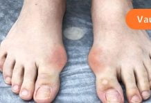 მე პოდაგრა აბზინდას გამოყენებით მოვიშორე.. მინდა გაგიზიაროთ რეცეპტი..