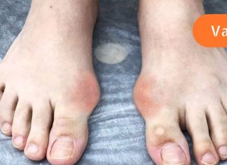 მე პოდაგრა აბზინდას გამოყენებით მოვიშორე.. მინდა გაგიზიაროთ რეცეპტი..