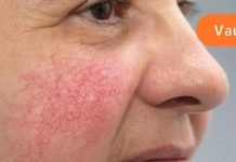 თუ გაწუხებს წვრილი წითელი ხაზები სახეზე მაშინ გამოიყენე ეს საშუალებები!