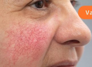 თუ გაწუხებს წვრილი წითელი ხაზები სახეზე მაშინ გამოიყენე ეს საშუალებები!