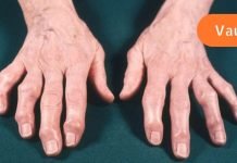 მედიცინის ფასდაუდებელი რეკომენდაციები ართრიტისა და ართროზის დროს!
